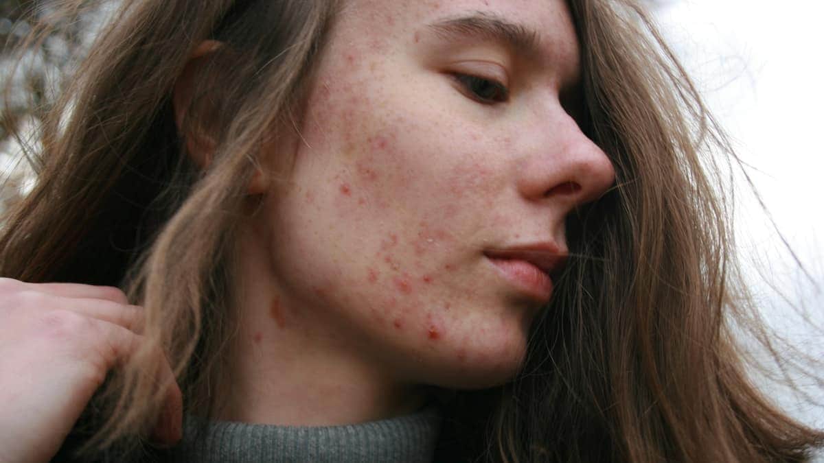Visage présentant des lésions d'acné inflammatoire sur la joue